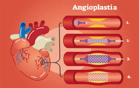 Angioplastia e Cateterismo: Um Guia Completo sobre Diagnóstico e Tratamento Vascular