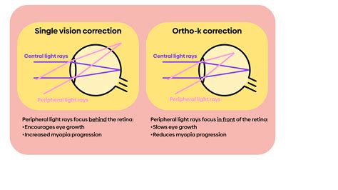 Annabel Pync: Pioneers of Ortho-K and Myopia Control