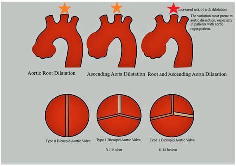 Aortic Root Dilatation: An Overview