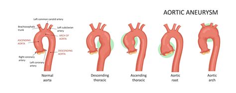 Aortic Root Dilatation (ICD-10 I35.1): An Overview