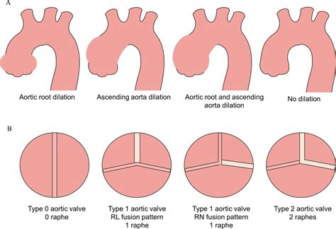 Aortic Root Dilatation ICD-10: A Comprehensive Guide to Diagnosis and Treatment