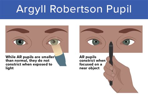 Argyll Robertson Pupil: An In-Depth Examination