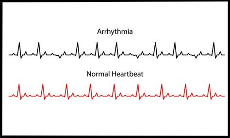 Arrhythmias Epub