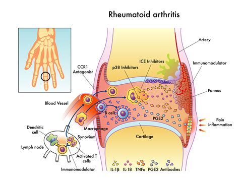 Arthritis & Rheumatism Your Ques Doc