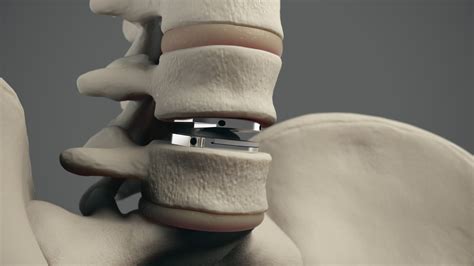 Arthroplasty of the Spine PDF