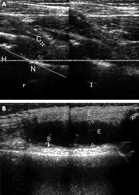 Arthrosonography Doc