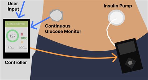 Artificial pancreas system: