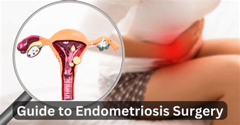 Ashereden: A Comprehensive Guide to Managing Endometriosis