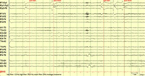 Atlas of Adult Electroencephalography Epub