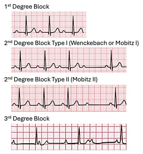 Atrioventricular Block 1st Degree: A Comprehensive Guide