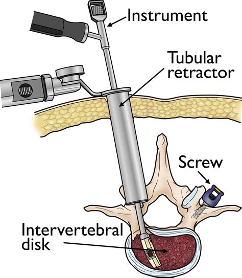 Ayukawa's Spine Surgery Techniques