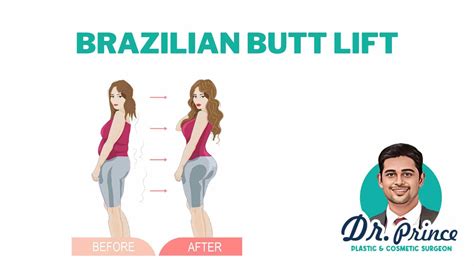 BBL Gal: A Complete Guide to Brazilian Butt Lifts