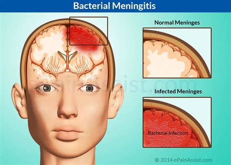 Bacterial Meningitis Kindle Editon