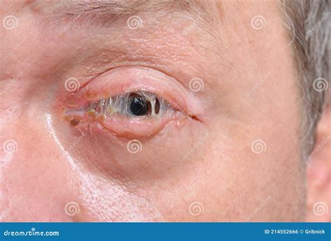 Bacterial pink eye