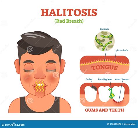 Bad breath (halitosis)