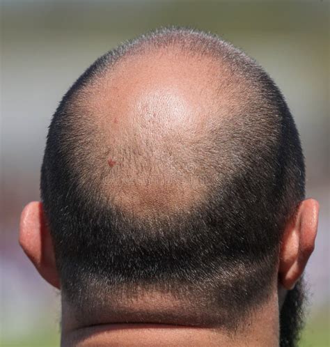 Bald Head Patches: A Comprehensive Guide