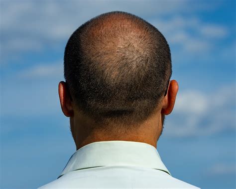 Balding Crown Styling: