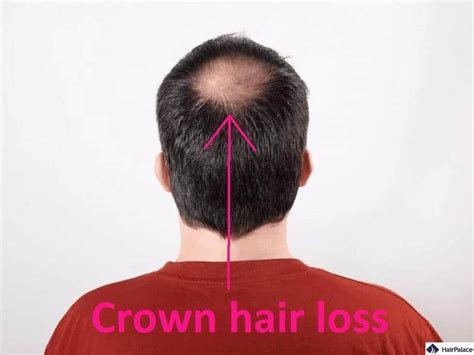 Balding Crown Styling: The Ultimate Guide