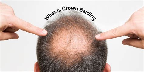 Balding Crown Woes: A Common but Treatable Problem