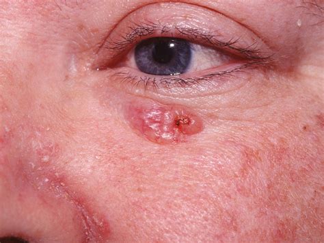 Basal cell carcinoma: