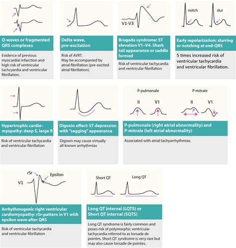 Basic Arrhythmias PDF