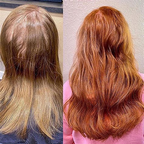 Before and After Hair Extensions for Thin Hair on Top: Regaining Volume and Confidence