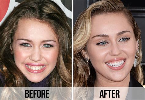 Before and After Photos of Tooth Celebrities