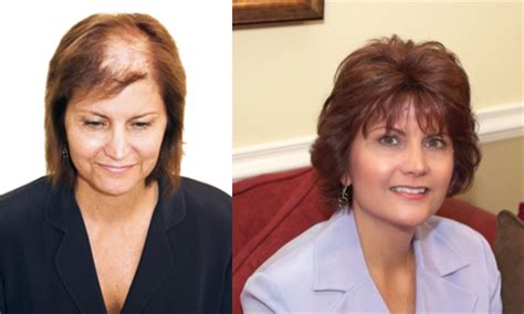 Bella Bella Wigs: A Solution for Hair Loss and Confidence