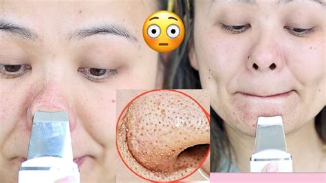 Benefits of Blackhead Removal Videos