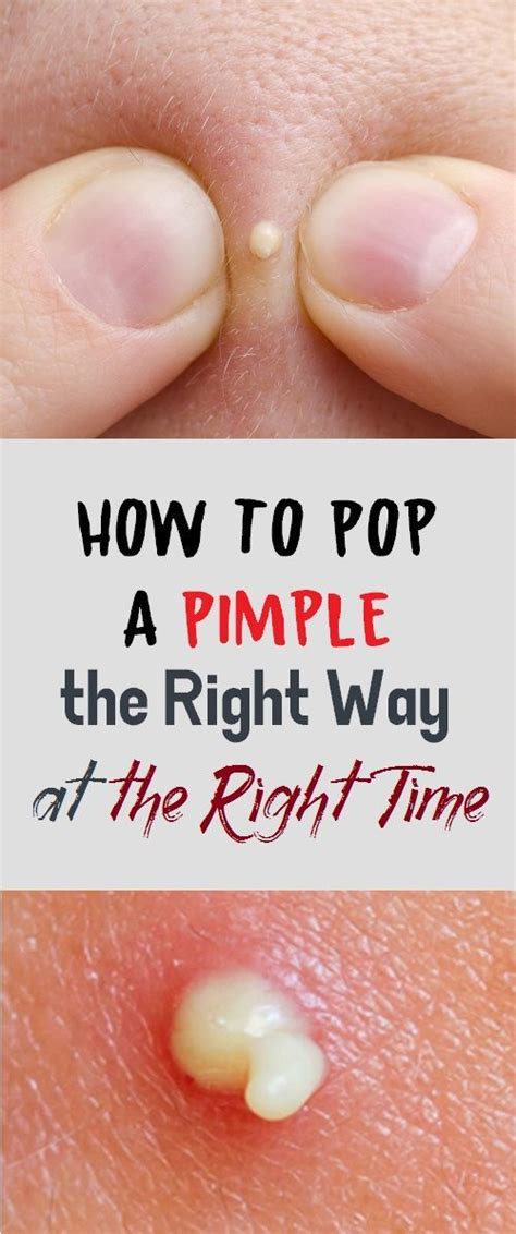 Benefits of Pimple Popping Videos