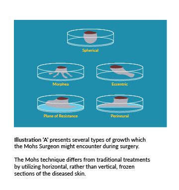 Benefits of Using a MOH Surgical Table: