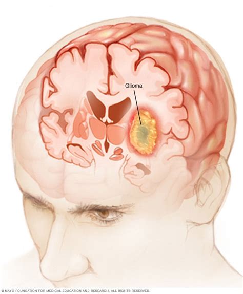 Benign Cerebral Gliomas Epub