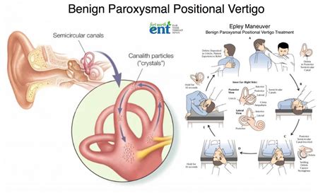 Benign Paroxysmal Positional Vertigo Treatment: Medications to Relieve Dizziness