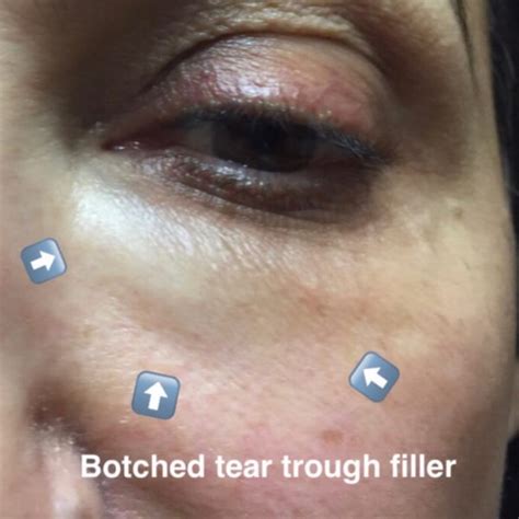 Beware: Avoid Botched Tear Trough Filler in 10,000 Characters