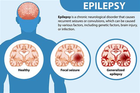 Beyond the Seizure: The Human Impact of Epilepsy