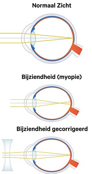 Bijziendheid bij kinderen: een toenemend probleem