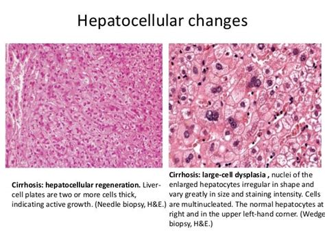 Biopsy Interpretation of the Liver Doc