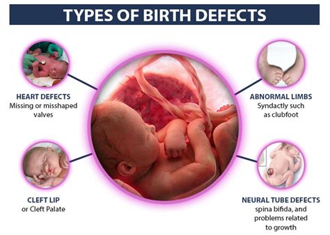 Birth defects: