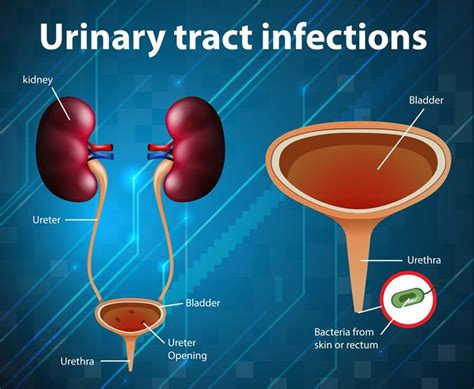 Bladder Infection with Blood Clots: A Deeper Dive