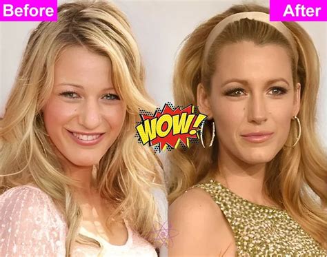 Blake Lively Plastic Surgery: A Comprehensive Analysis