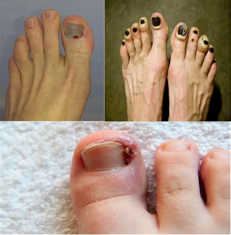 Blister Under Toenail: A Comprehensive Guide to Causes, Symptoms, Treatment, and Prevention