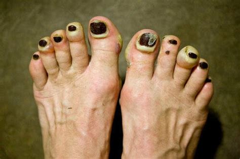 Blister Under Toenail: Everything You Need to Know, from Prevention to Treatment