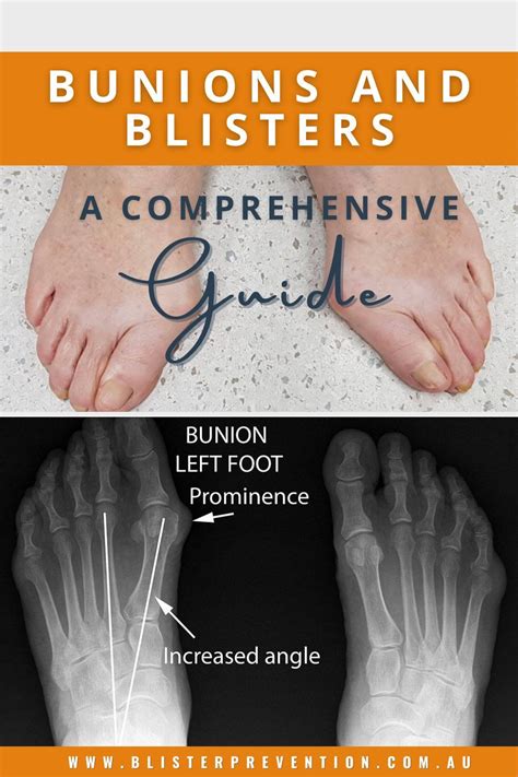 Blister from Shoes on Toe: A Comprehensive Guide to Prevention, Treatment, and Recovery