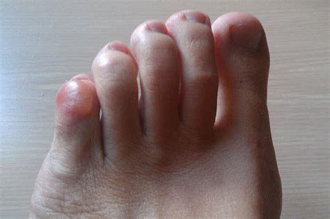 Blister in Pinky Toe: An In-Depth Guide