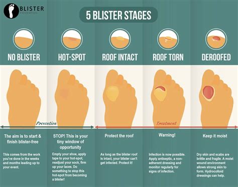 Blisters from Shoes: Prevention and Treatment