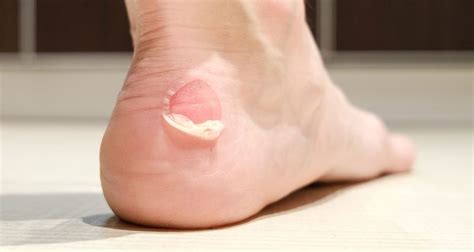 Blisters on Your Heels from Shoes? Break Free with Our Unbeatable Guide!