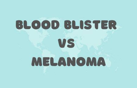 Blood Blisters vs. Melanoma: Spotting the 5 Key Differences