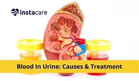 Blood in Urine (Hematuria) in Females: Causes, Treatments, and Prevention