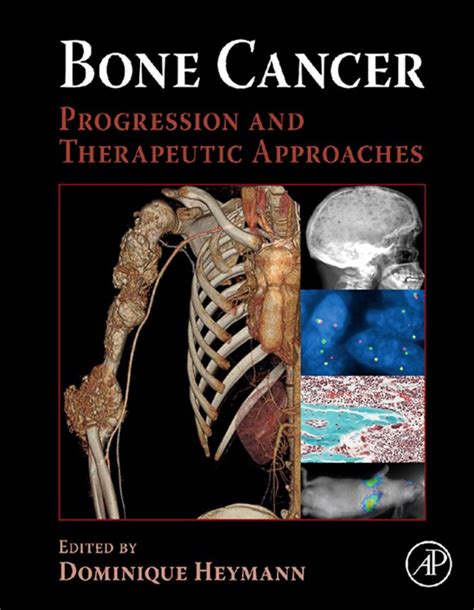 Bone Cancer Progression and Therapeutic Approaches 1st Edition Kindle Editon