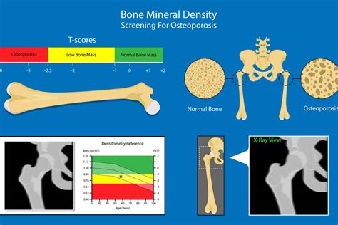 Bone Density Scores Chart